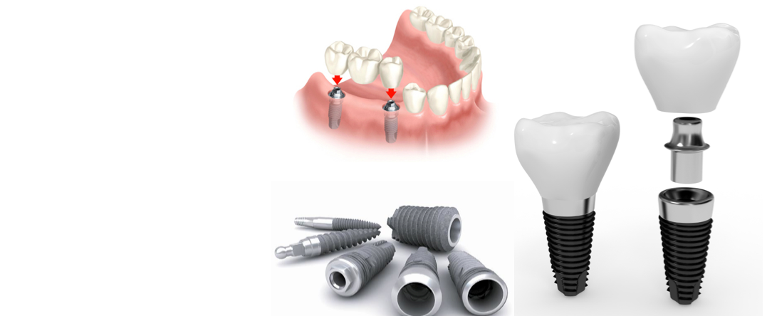 Вам необходимо лечение с помощью зубного имплантата?
Вас интересует процедура лечения?
Каковы преимущества или ограничения?
Подробнее в новом разделе об имплантатах >>>
